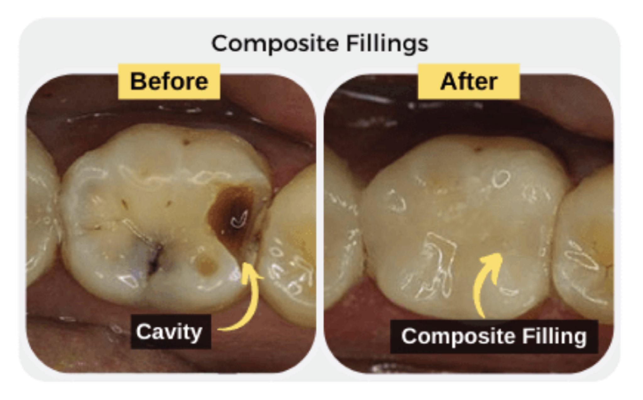 Before and after composite dental filling