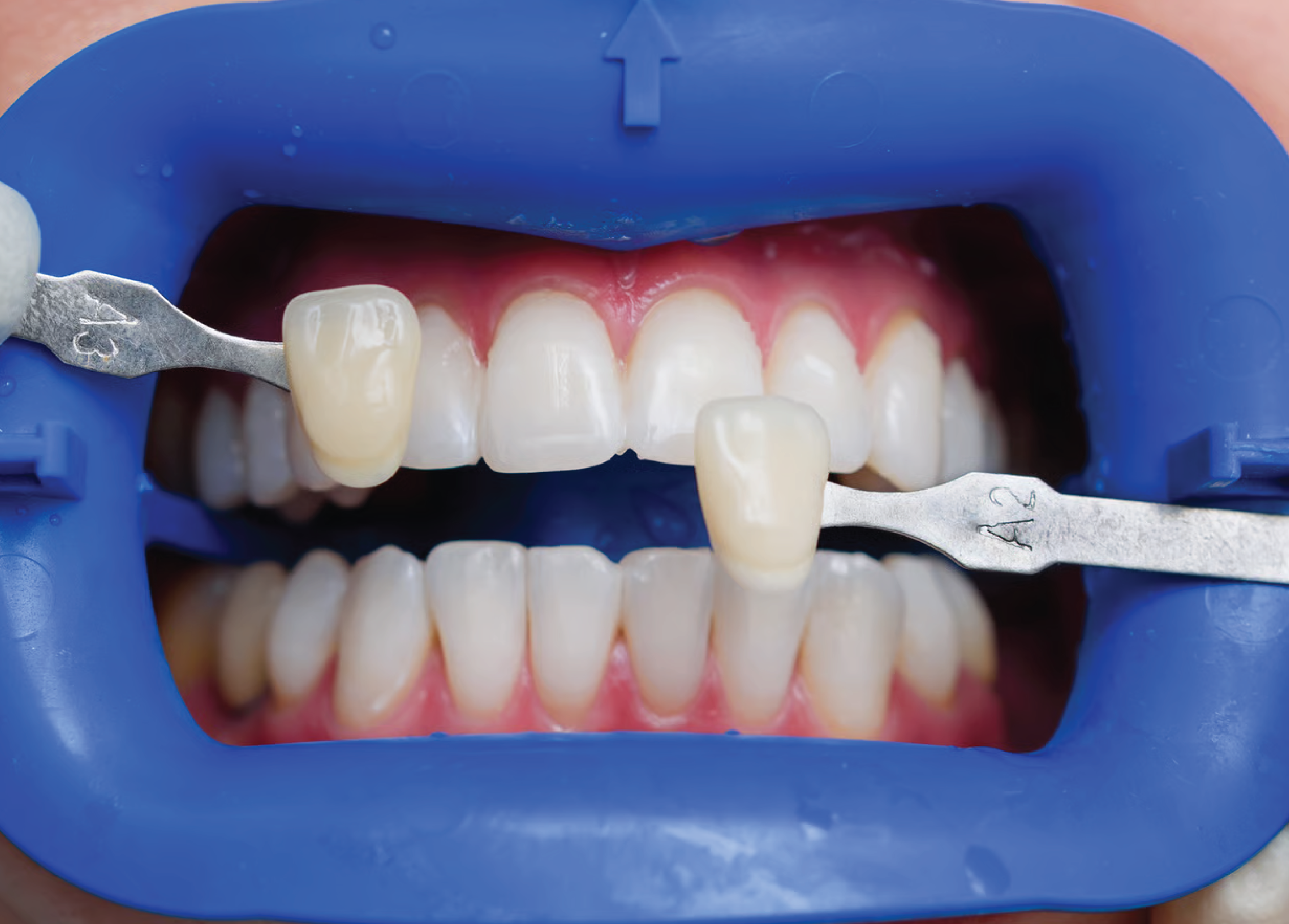 Dental veneer fabrication and finishing