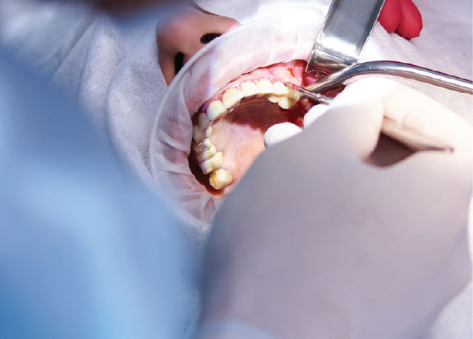 Dental extraction procedure