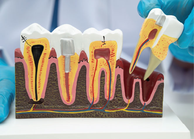 Dental tooth extraction model