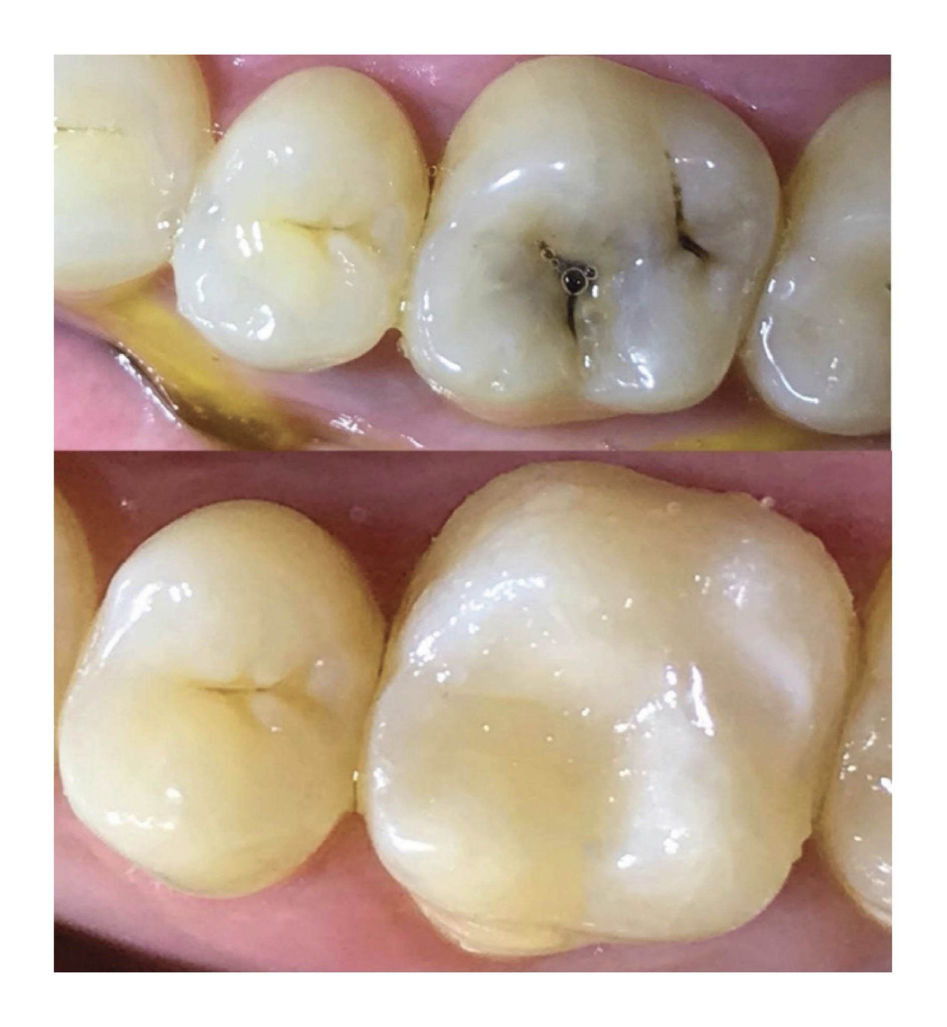 Dental filling before and after treatment