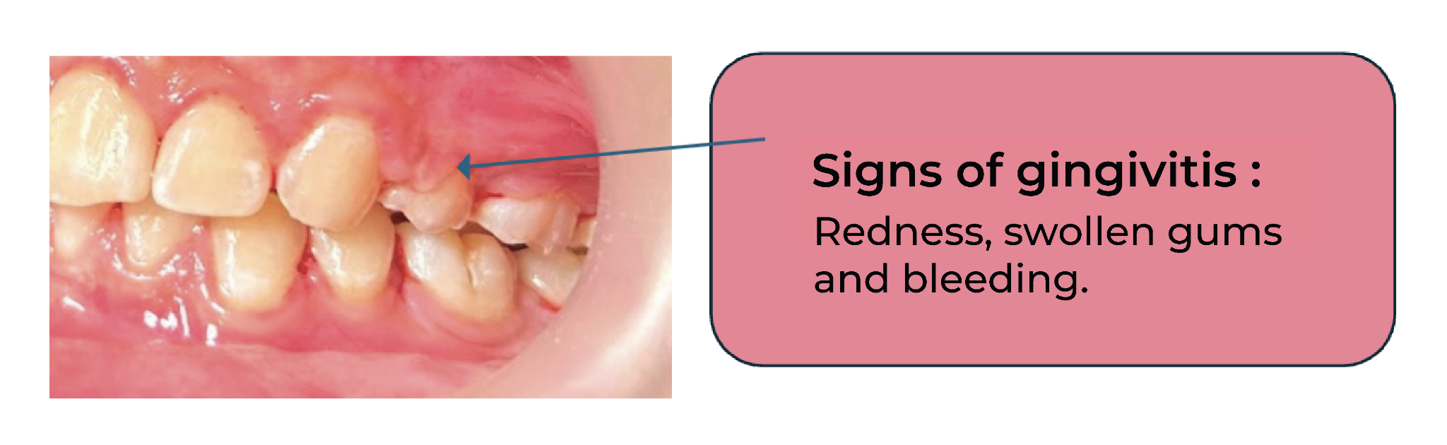 Clinical example showing redness, swelling and bleeding associated with gingivitis