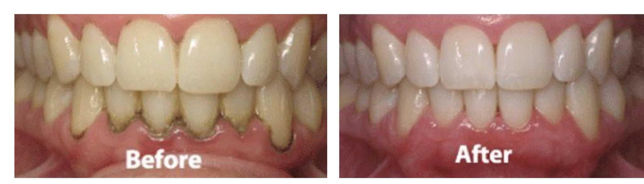 Before and after clinical photographs related to periodontal gum treatment