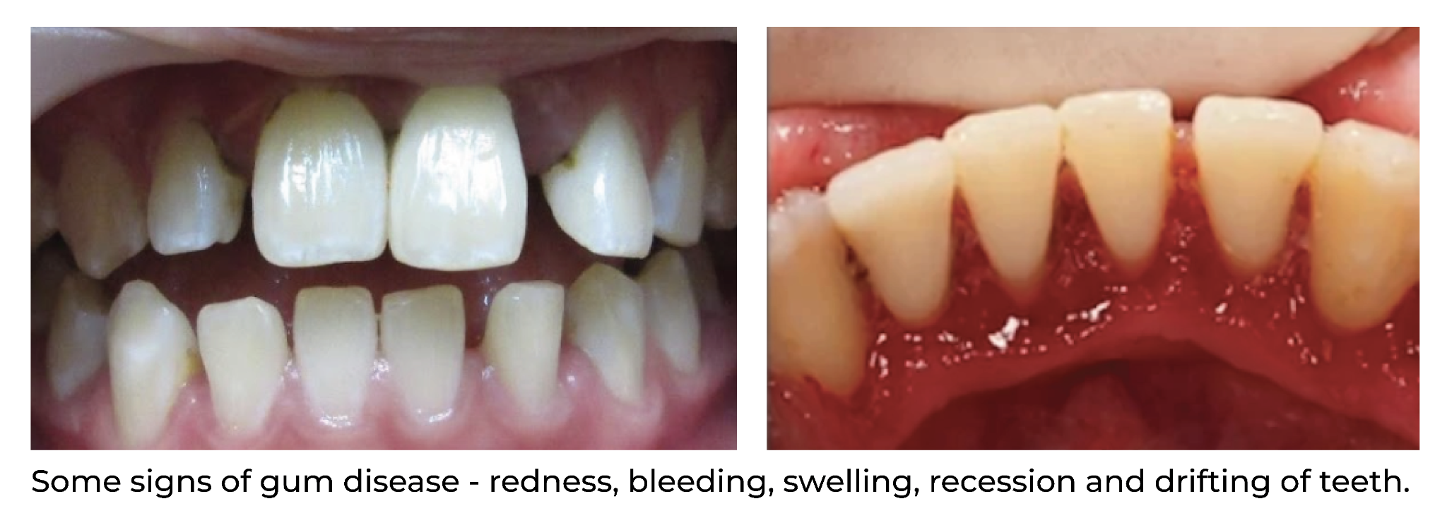 Clinical examples of gum disease including recession, inflammation and drifting of teeth