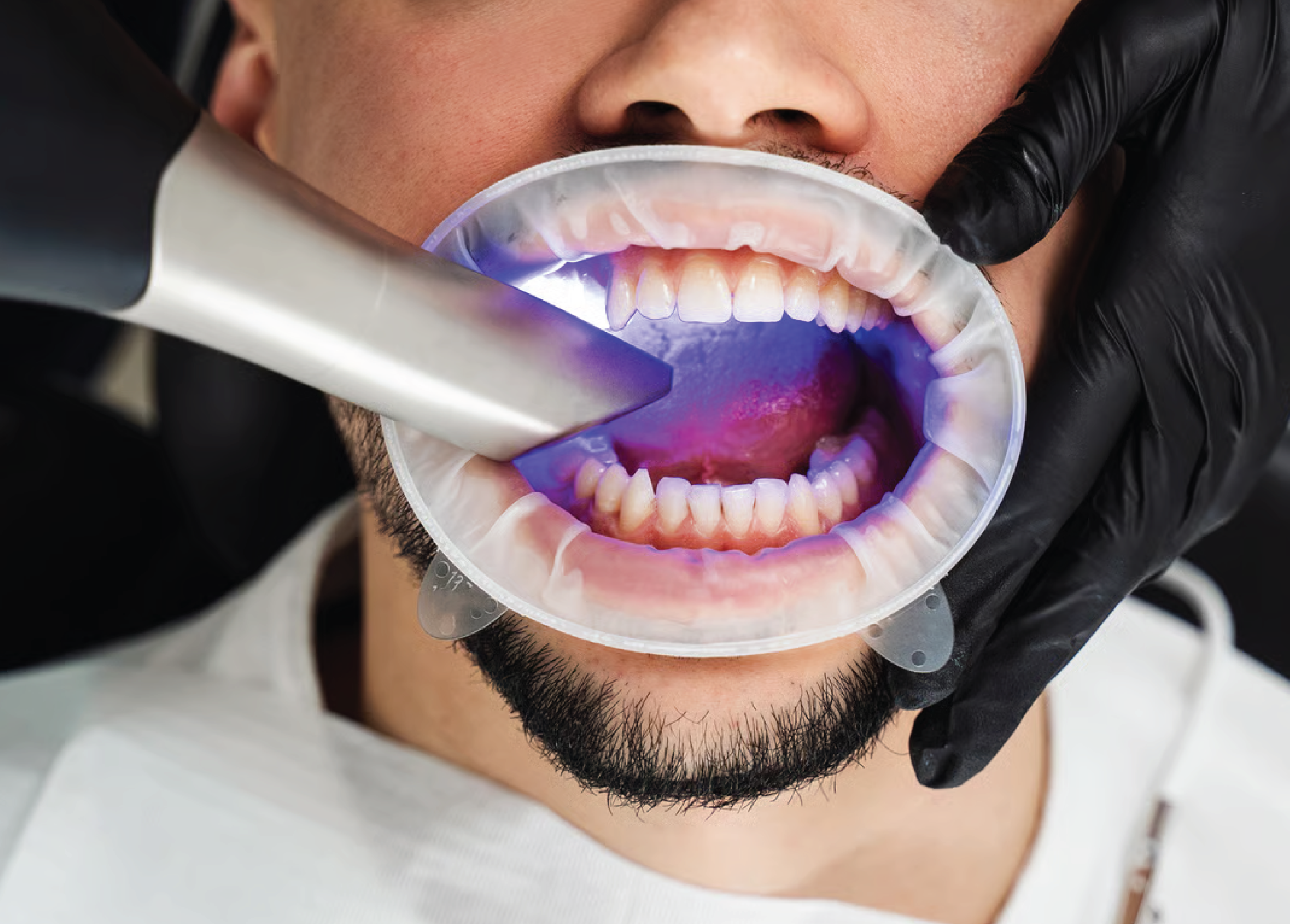 Professional teeth whitening shade assessment