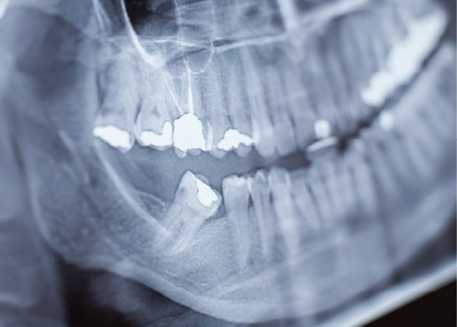 Dental X-ray showing wisdom tooth