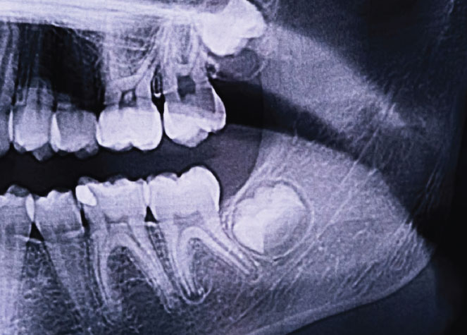Wisdom tooth dental treatment